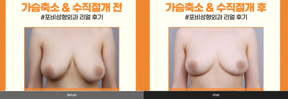  전후사진